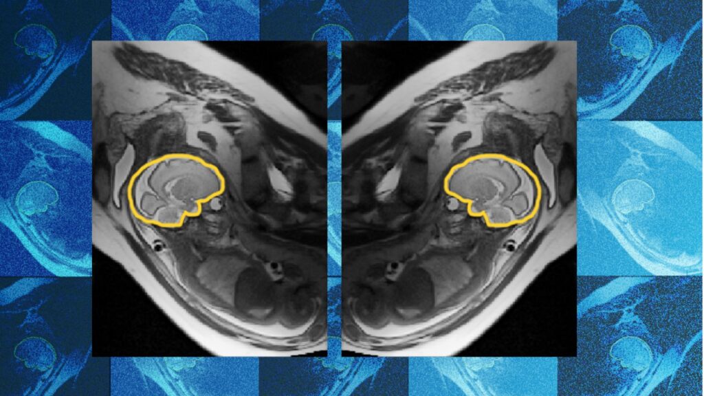 Why teaching AI about symmetry could make prenatal diagnosis more reliable | MIT News